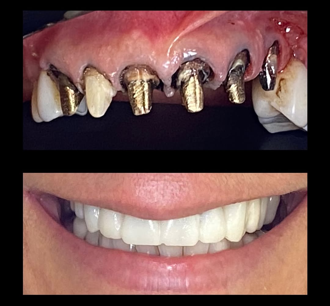 Prótese e Estética (antes e depois)